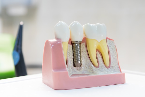 Can Dental Implants Replace Molar Teeth?