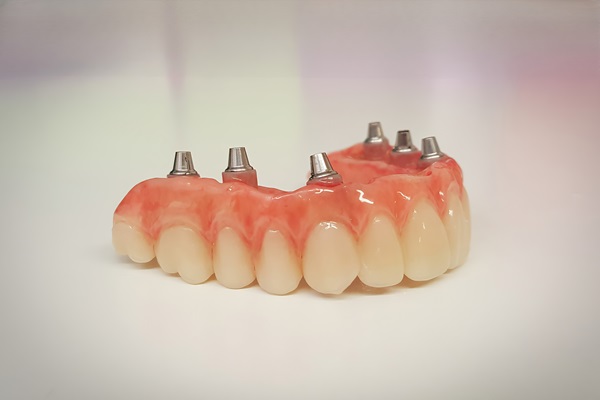 Why Choose Implant Supported Dentures?