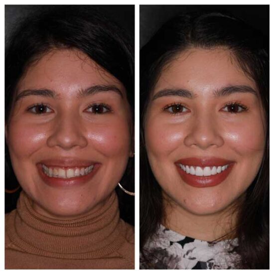 Dentist in Totowa, NJ Smile Gallery b Dental Spa at Totowa Before