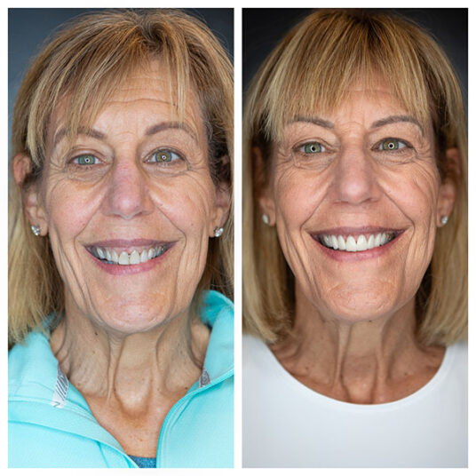 Dentist in Totowa, NJ Smile Gallery b Dental Spa at Totowa Before