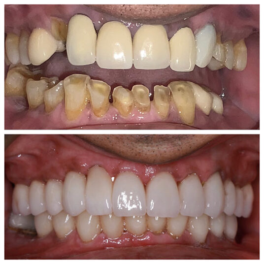 Dentist in Totowa, NJ Smile Gallery b Dental Spa at Totowa Before