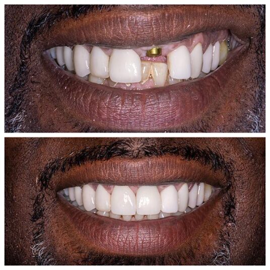 Dentist in Totowa, NJ Smile Gallery b Dental Spa at Totowa Before