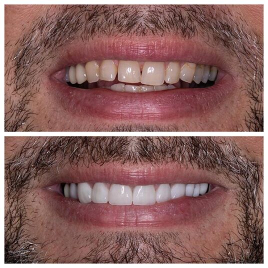 Dentist in Totowa, NJ Smile Gallery b Dental Spa at Totowa Before