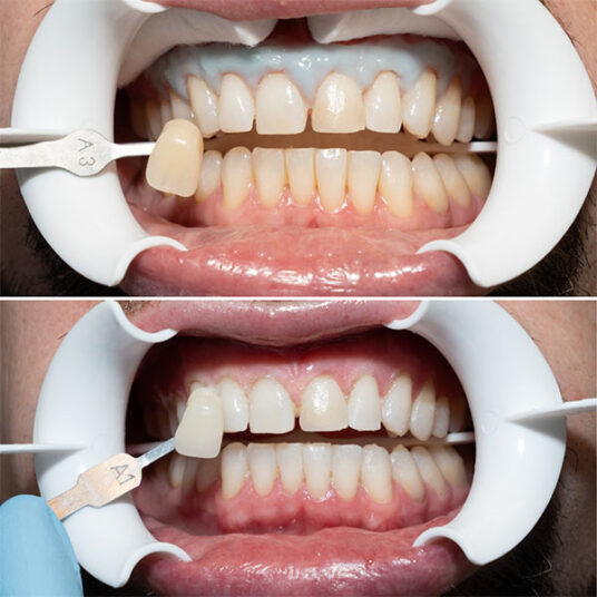 Dentist in Totowa, NJ Smile Gallery b Dental Spa at Totowa Before