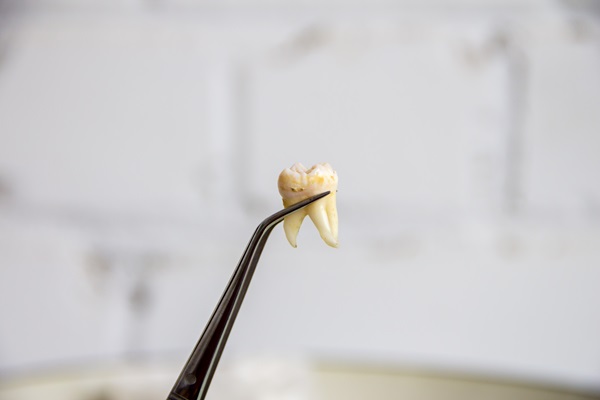 A Step By Step Guide To A Tooth Extraction Procedure